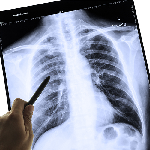Don’t Overlook These Other Occupational Respiratory Illnesses