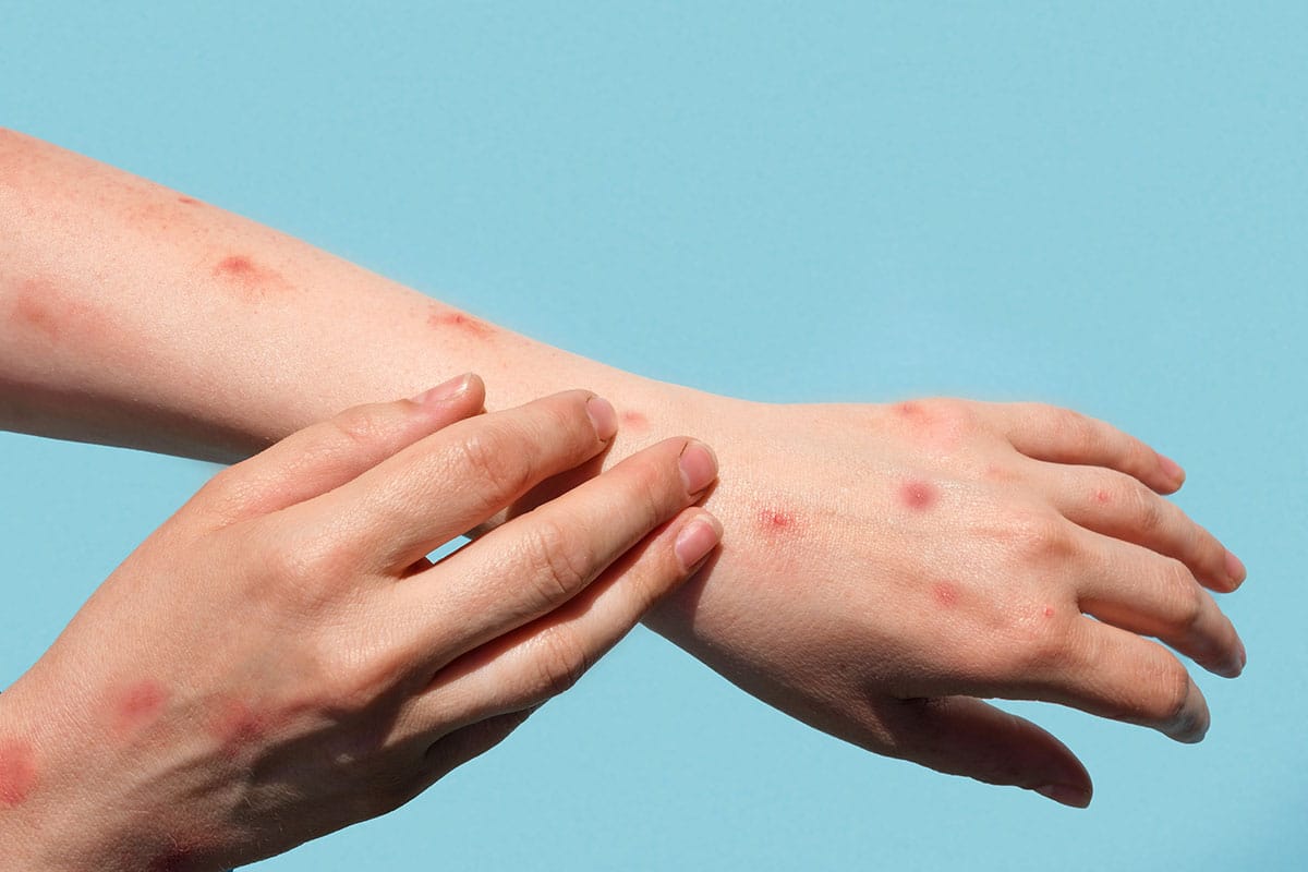 Monkeypox rash breaks out on man's arm